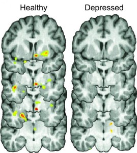 The brains of healthy individuals (left column) released natural opioids during social rejection (colored spots) that may help to reduce negative emotions associated with rejection. In contrast, study participants with depression (right column) did not release nearly as many opioids, which may contribute to a lingering depressed mood following rejection. Credit: University of Michigan